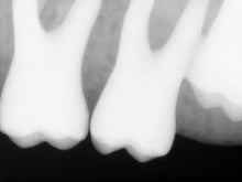 Load image into Gallery viewer, Carestream RVG 6100 Dental Intraoral X-Ray Sensor Size 1
