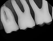 Load image into Gallery viewer, Dexis Platinum Dental X-Ray Sensor Size 2 PerfectSize Direct USB 64 bit
