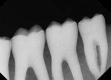 Load image into Gallery viewer, DentiMax Dream Sensor Size 2 Digital Dental X-Ray Sensor
