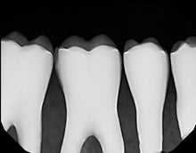Load image into Gallery viewer, Dexis Platinum Dental Intraoral X-Ray Sensor Size 2
