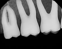 Load image into Gallery viewer, Dexis Platinum V10 Digital Intraoral X-Ray Sensor Size 2 USB Dental Imaging
