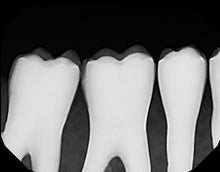 Load image into Gallery viewer, Dexis Platinum V10 Digital Intraoral X-Ray Sensor Size 2 USB Dental Imaging
