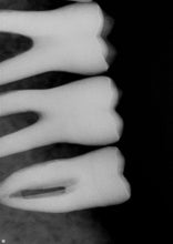 Load image into Gallery viewer, Schick CDR Elite Size 1 Digital Dental Intraoral X-Ray Sensor
