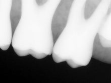 Load image into Gallery viewer, Carestream RVG 6200 Size 1 Digital Dental X-Ray Sensor
