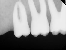 Load image into Gallery viewer, Carestream RVG 6200 Size 2 Digital Dental X-Ray Sensor
