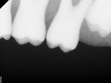 Load image into Gallery viewer, Carestream RVG 6200 Size 2 Digital Dental X-Ray Sensor
