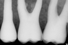 Load image into Gallery viewer, Sirona Schick CDR Elite Dental Intraoral X-Ray Sensor Size 1
