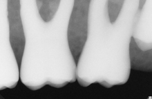 Load image into Gallery viewer, Sirona Schick CDR Elite Dental Intraoral X-Ray Sensor Size 1
