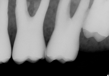 Load image into Gallery viewer, Sirona Schick CDR Elite Dental Intraoral X-Ray Sensor Size 2
