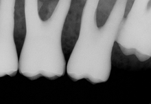 Load image into Gallery viewer, Sirona Schick CDR Elite Dental Intraoral X-Ray Sensor Size 2
