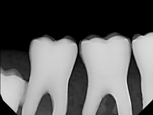 Load image into Gallery viewer, Dexis Platinum Dental Intraoral X-Ray Sensor Size 2
