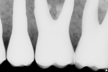 Load image into Gallery viewer, Sirona Schick CDR Elite Dental Intraoral X-Ray Sensor Size 1
