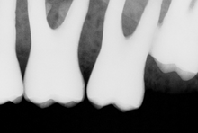 Load image into Gallery viewer, Sirona Schick CDR Elite Dental Intraoral X-Ray Sensor Size 2
