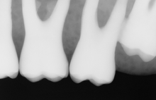 Load image into Gallery viewer, Schick Elite 33 Dental Intraoral X-Ray Sensor Size 2
