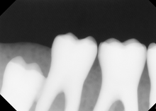 Load image into Gallery viewer, XDR Dental Intraoral X-Ray Sensor Size 2
